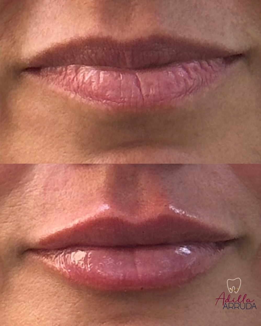 Preenchimento Labial (antes e depois)